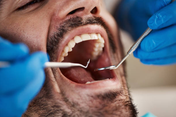 Best Emergency Dentist for Lost Fillings or Crowns in St Charles, IL